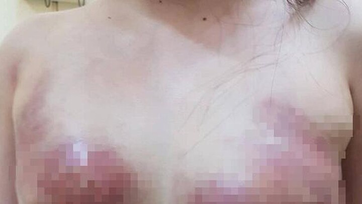 Tin tức đời sống mới nhất ngày 12/1/2019: Vòng 1 biến dạng sau 3 ngày bơm mỡ nhân tạo nâng ngực