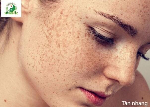 Nguyên nhân gây nám da và các giải pháp trị nám