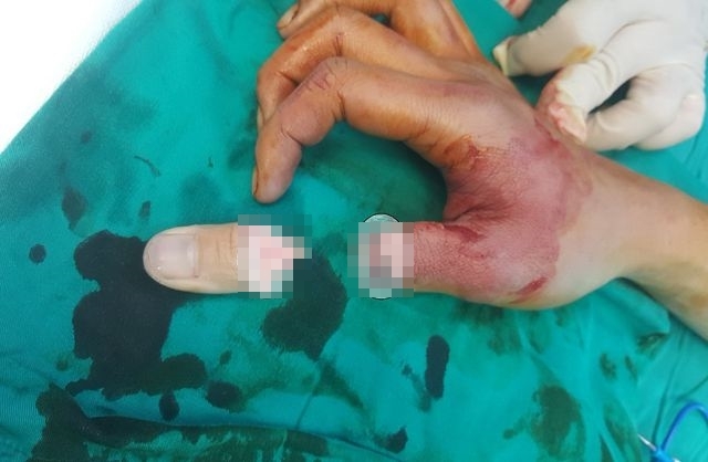 Đà Lạt: Thanh niên bị cáp viễn thông vướng vào người, đứt lìa ngón tay