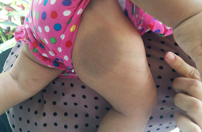 Bé gái 8 tháng tuổi khóc thét, nghi bị mẹ nuôi bạo hành trong phòng trọ