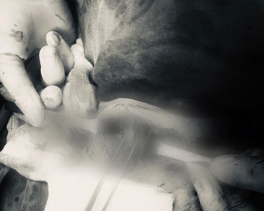 Thanh niên 9X bị đâm thấu cổ được cứu sống