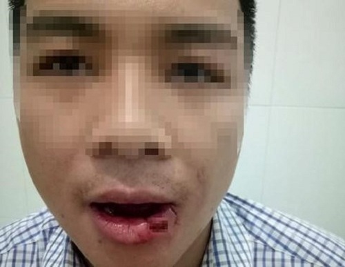 Khởi tố thầy giáo ném thanh sắt làm nhân viên tòa án gãy 5 cái răng