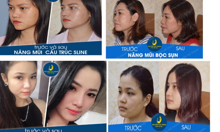 Phẫu thuật nâng mũi - Nên hay không?