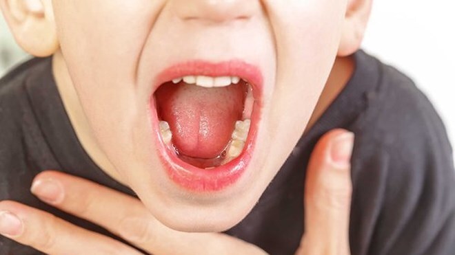 Dễ dàng phòng viêm amidan khi thời tiết giao mùa với 5 cách đơn giản sau