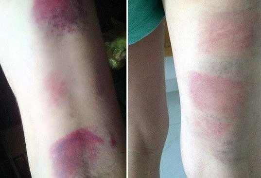 Bộ GD-ĐT vào cuộc vụ giáo viên đánh tím chân 22 học sinh ở Vũng Tàu