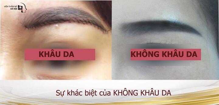 Làm đẹp bằng phẫu thuật không khâu da: Liệu có an toàn và “thần thánh” như đồn thổi?