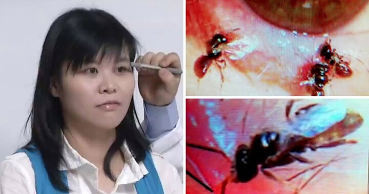 Kỳ lạ người phụ nữ có 4 con ong sống trong mắt