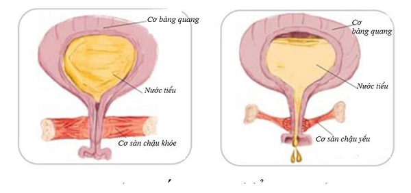 Tiểu són, tiểu nhiều lần, tiểu gấp, hội chứng bàng quang kích thích: Phải làm sao? 