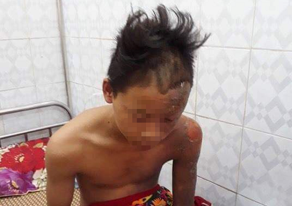 Bị sét đánh trúng đầu, cậu bé Thanh Hóa may mắn thoát chết