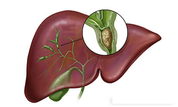 Sỏi gan có nguy hiểm không? Coi chừng phải mổ gan lấy sỏi