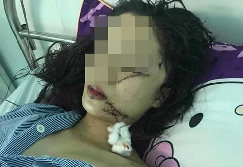 Tin tức pháp luật mới nhất ngày 23/4/2019: Lộ nguyên nhân bất ngờ vụ cô gái 18 tuổi bị rạch mặt, khâu 60 mũi