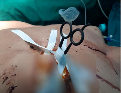 Kinh hãi người đàn ông 41 tuổi nhập viện với cây kéo còn cắm sâu vào ngực