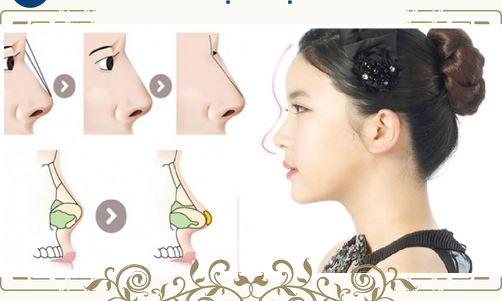 Nâng mũi bọc sụn là như thế nào?