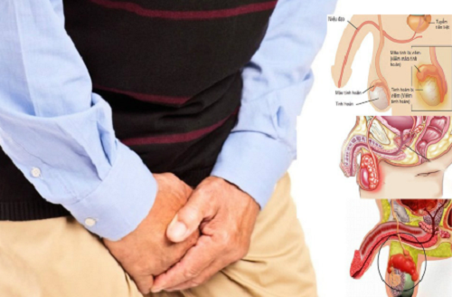 Hé lộ nguyên nhân phổ biến gây viêm mào tinh hoàn khiến nam giới có thể vô sinh