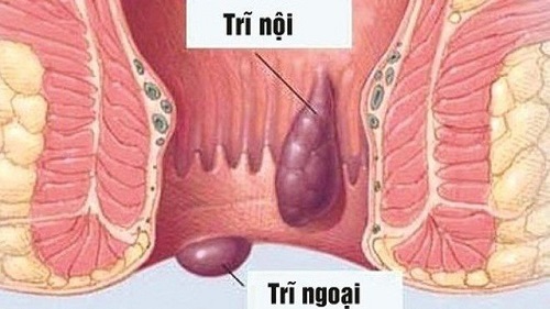 Nỗi ám ảnh bệnh trĩ mùa nắng nóng và cách phòng tránh hiệu quả