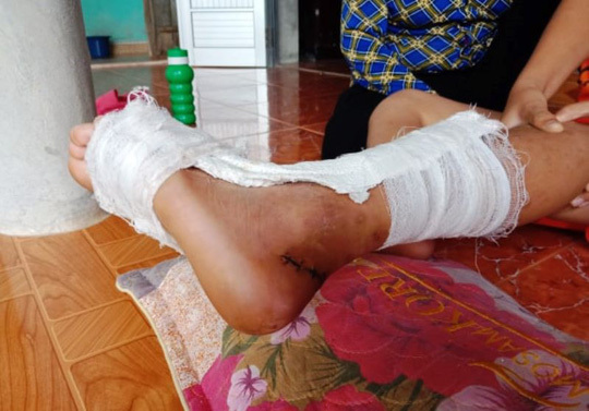 Làm rõ thông tin học sinh tiểu học đứt gân chân tại trường ở Thanh Hóa