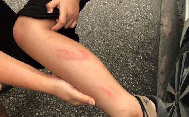 Cô giáo tát học sinh tiểu học bầm tím thái dương, tấy đỏ chân vì làm bài chậm