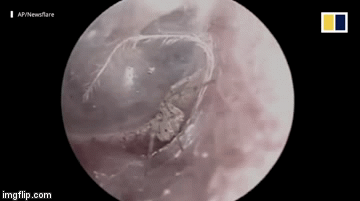 Rợn người vì xem clip gắp nhện làm tổ bên tai người đàn ông