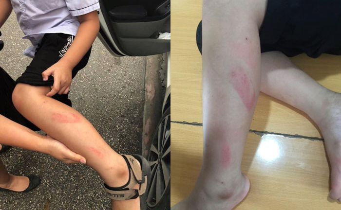 Hải Phòng: Đình chỉ công tác nửa năm cô giáo bạt tai, vụt thước kẻ tấy đỏ chân học sinh