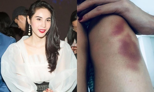 Thủy Tiên bị chấn thương khi đang tập vũ đạo