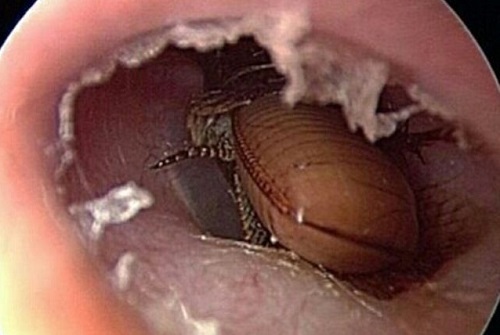 Video: Rùng mình chứng kiến cảnh bác sĩ đuổi gián ra khỏi tai bệnh nhân