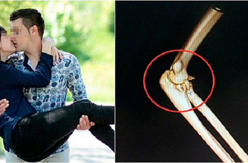 Nam thanh niên bất ngờ bị gãy khuỷu tay khi bế bạn gái 70 kg