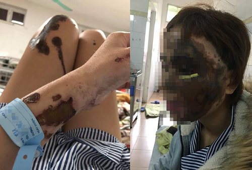 Nạn nhân bị cựu thiếu úy tạt axit ở Đà Nẵng: Chỉ mong là giấc mơ nhưng sự thật thì tàn khốc
