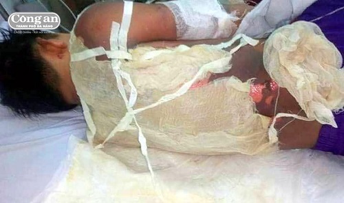 Quảng Nam: Mải mê lấy tổ chim, nam sinh phải nhập viện cấp cứu vì bị điện giật