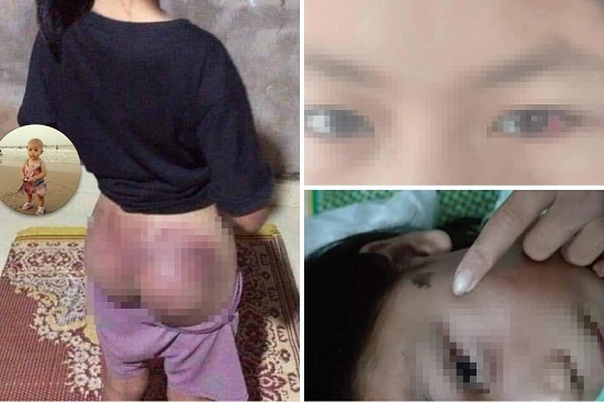 Nghi trộm 50.000 đồng, công an viên đánh bé gái 12 tuổi nhập viện