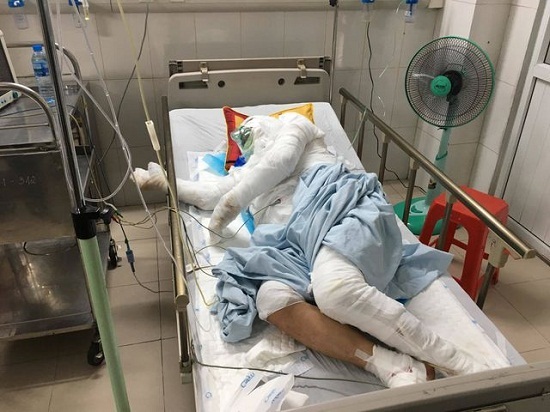 Bị bén lửa toàn thân sau tai nạn, cụ ông thương binh vẫn cố cứu con gái 6 tuổi