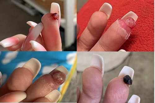 Làm nail ở cửa hàng, cô gái suýt phải cắt cụt ngón tay