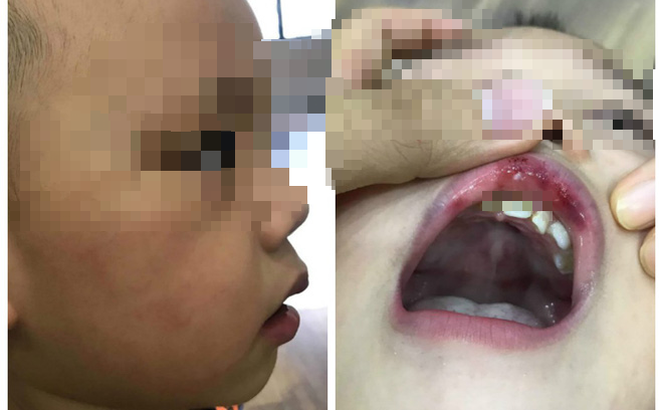 Hà Nội: Đóng học phí gần 10 triệu/ tháng, con bị cô giáo tát bầm tím môi, mặt in lằn 5 ngón tay