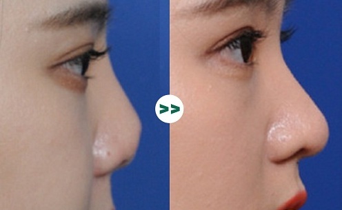 90% chị em lựa chọn nâng mũi cấu trúc khi phẫu thuật thẩm mỹ, tại sao?