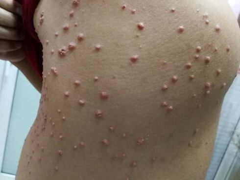 Những quý ông thích ăn nhậu cẩn thận bị mọc u lạ khắp người
