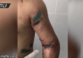 Video: Xót xa thương tích của bé gái 7 tuổi bị tra tấn, suýt phải cắt bỏ cả cánh tay