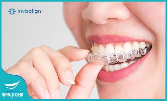 Lựa chọn niềng răng bằng khay trong suốt, những điều sẽ khiến bạn
