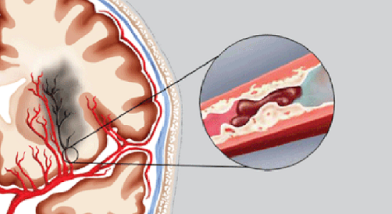 Thực phẩm bảo vệ sức khỏe Nattospes – Giải pháp cho người bị đột quỵ não