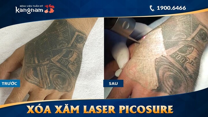 Xóa hình xăm giá rẻ và hiểm họa khôn lường