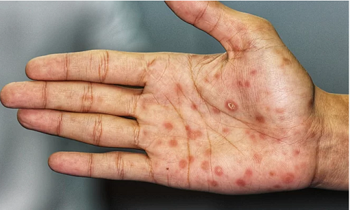 Con trai 13 tuổi mắc bệnh giang mai, cha mẹ sốc nặng khi biết lý do