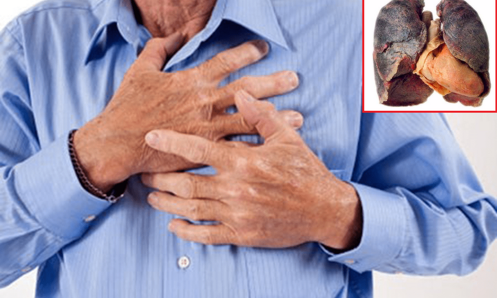 Dù đã bỏ hút thuốc nhiều năm, ung thư phổi vẫn là mối 