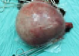 Cô gái mắc bệnh kỳ dị nhất thế giới được phẫu thuật thành công