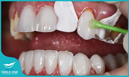 Nói không với mài răng bằng công nghệ Dán sứ Veneer Variolink ES hoàn toàn mới