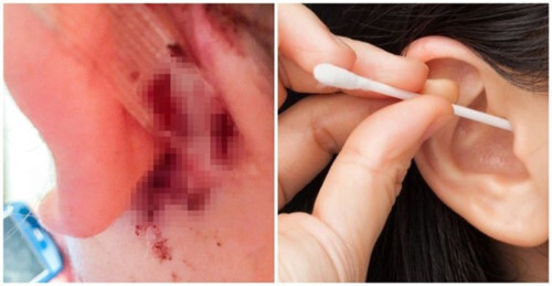 Tin tức đời sống mới nhất ngày 18/8/2019: Dùng tăm bông lấy ráy tai, người phụ nữ suýt tử vong