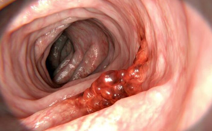 Bỏ qua dấu hiệu ung thư đơn giản, người đàn ông đột ngột tử vong 2 tuần sau khi phát hiện bệnh