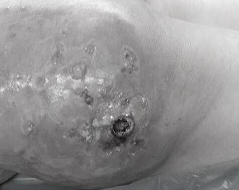 Tin tức đời sống mới nhất ngày 25/8/2019: Bơm silicon lỏng làm đẹp, người phụ nữ bị hoại tử vùng mông