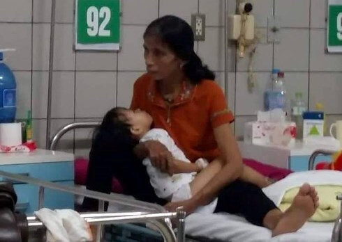 Bé gái 3 tuổi nhập viện với vết thương hoại tử do rắn hổ mang bò vào nhà cắn