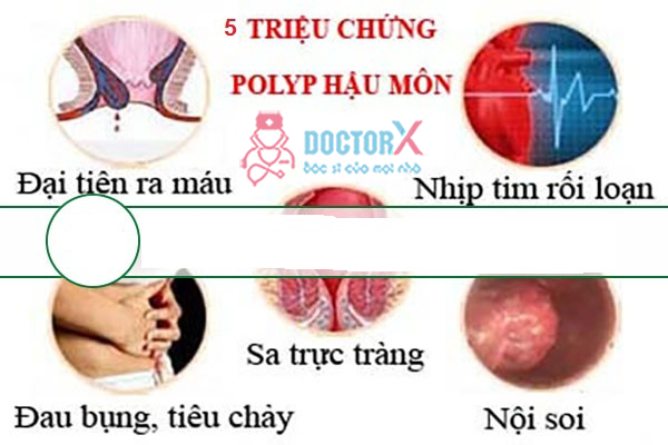 Polyp hậu môn có nguy hiểm không?