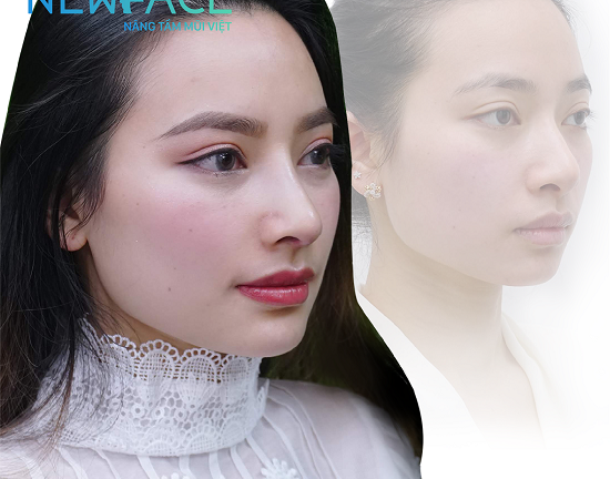 Tuyết Linh: “Sau khi nâng mũi, gương mặt mình trông “Tây” hơn rất nhiều!”