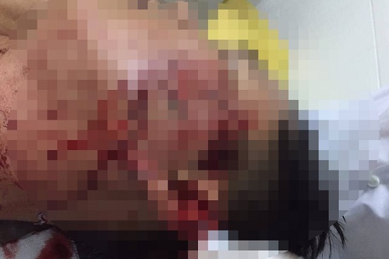 Mâu thuẫn trong quán nhậu, người đàn ông dùng ly bia đập vào mặt khiến đại úy công an trọng thương