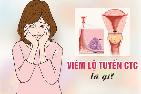 Địa chỉ chữa viêm lộ tuyến cổ tử cung ở Hà Nội